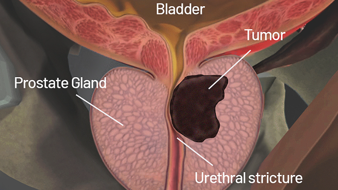 Sols Prostate Cancerのバナー