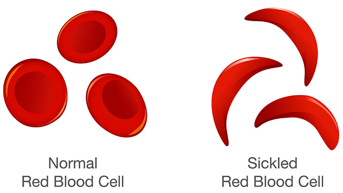 Sickle Cell Awarenessのバナー