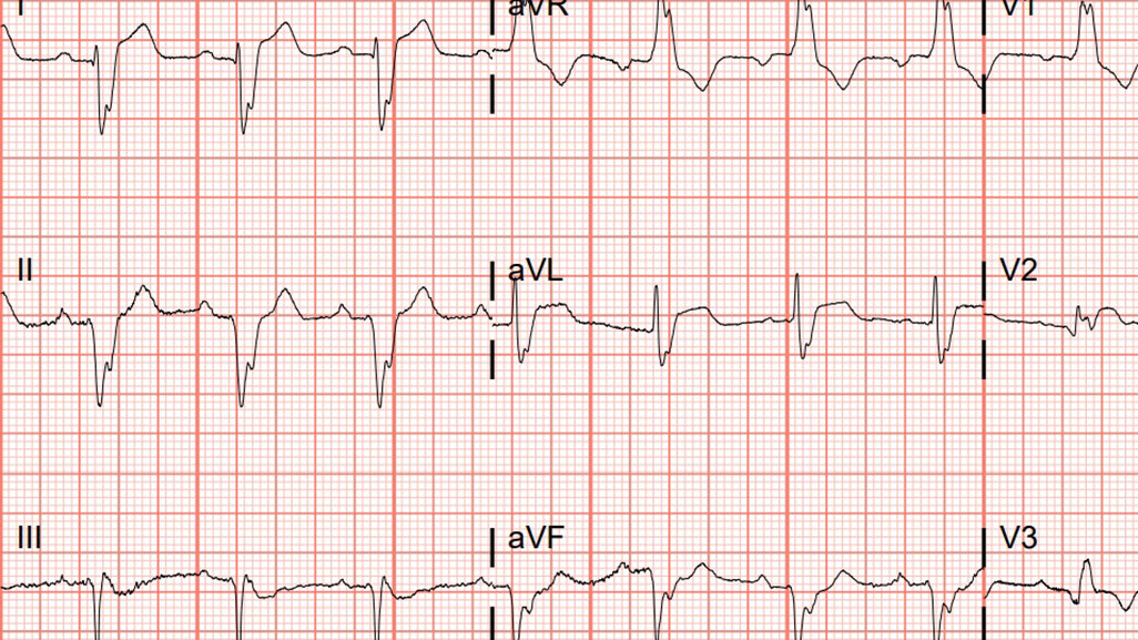 Bundle Branch Block